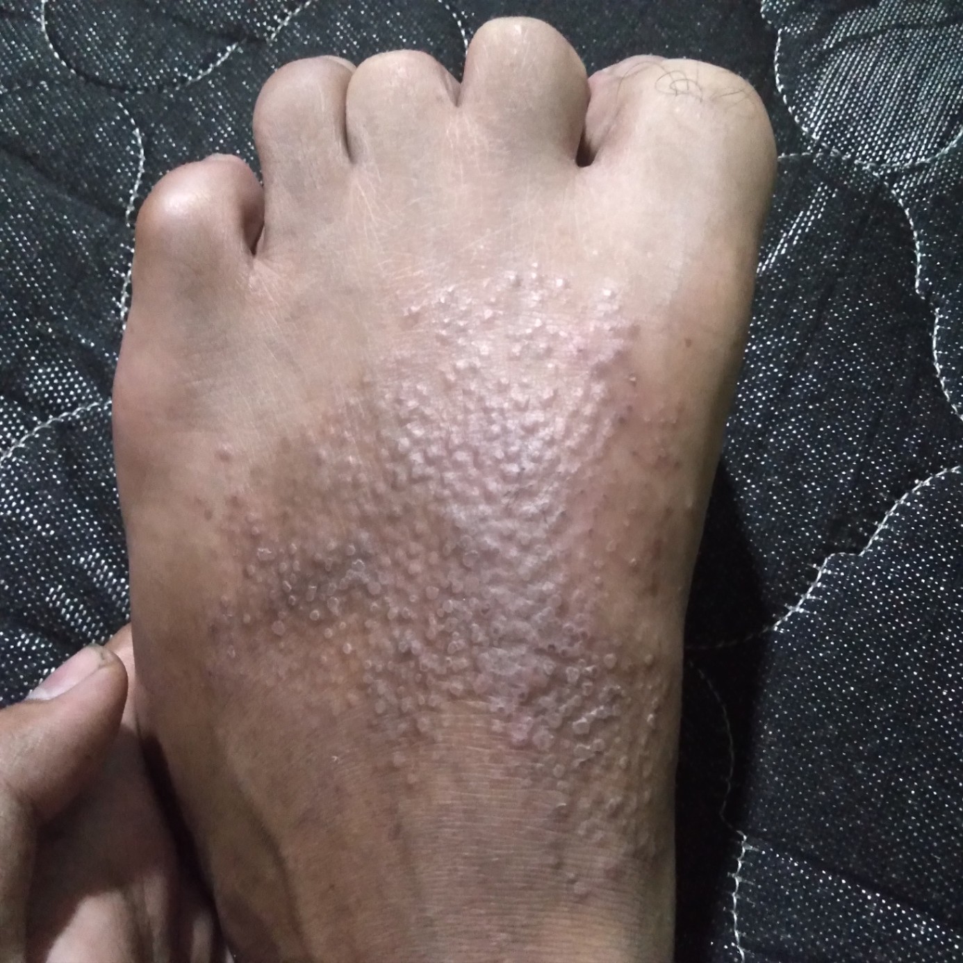 Gatal pada punggung kaki