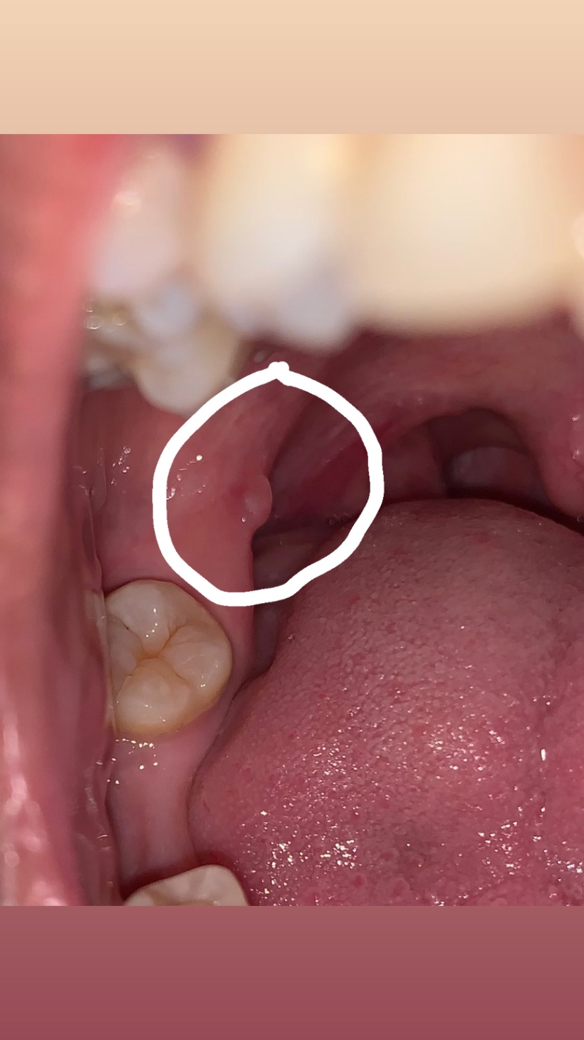 benjolan di gusi rongga mulut belakang