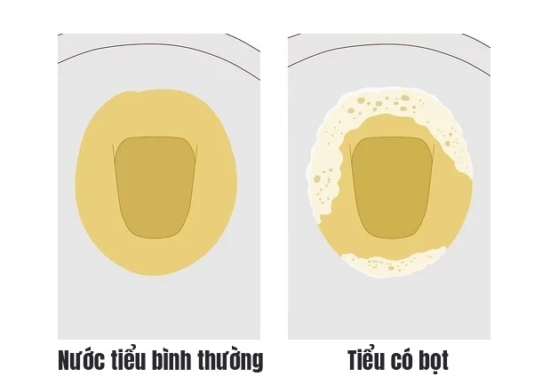 Nước tiểu có bọt ở nữ giới: Nguyên nhân, nguy hiểm và cách xử lý