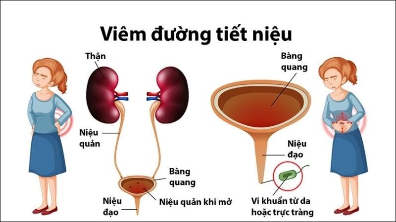 Viêm đường tiết niệu ở nữ uống thuốc gì?