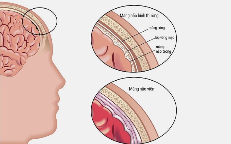 Viêm màng não là gì? Nguyên nhân, triệu chứng và cách phòng ngừa