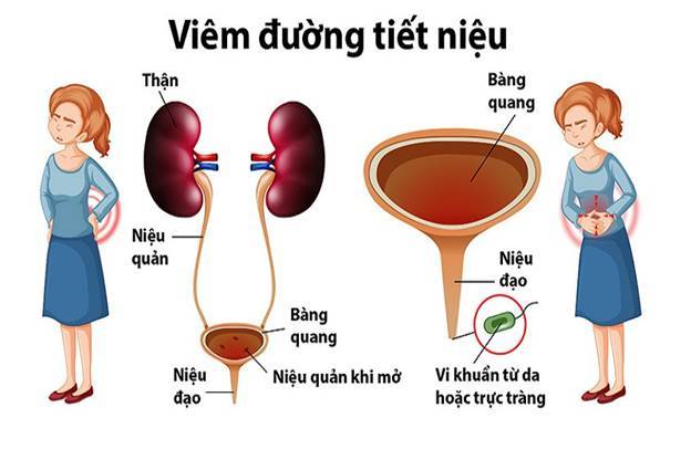 Nhiễm khuẩn tiết niệu là gì? Dấu hiệu thường gặpNhiễm