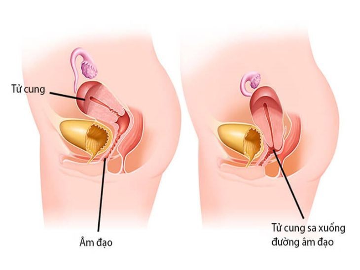 Dấu hiệu sa tử cung chị em nào cũng nên