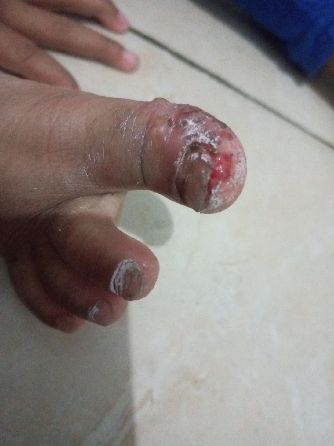 Infeksi kulit bagian jempol kaki