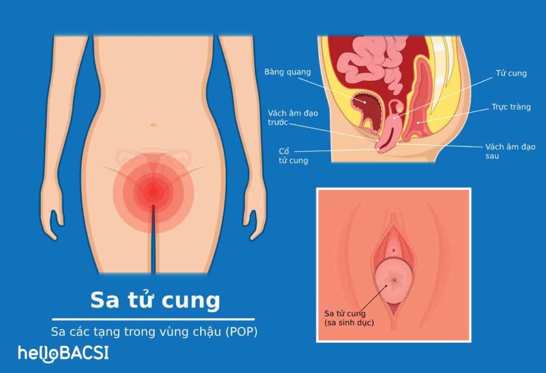 Cách nhận biết sa tử cung bằng tay chị em nào cũng nên biết 