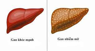 Gan Nhiễm Mỡ: Nguyên Nhân, Triệu Chứng Và Cách Điều Trị