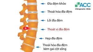 Thoát vị đĩa đệm