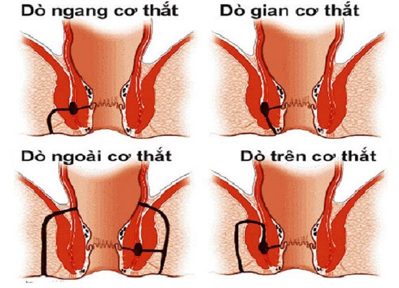 Rò hậu môn có nguy hiểm không, triệu chứng cảnh báo bệnh là gì?