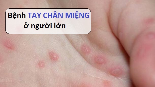 Người Lớn Có Bị Tay Chân Miệng Không? Các Thông Tin Quan Trọng Cần Biết