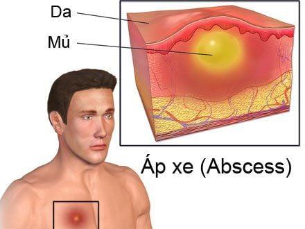 Áp xe có nguy hiểm không? Tất cả những gì bạn cần biết về bệnh này