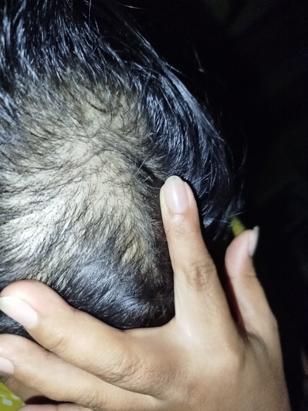 Dok saya kalau lagi banyak beban pikiran suka cabut2 rambut sampai rambut sya jadi botak