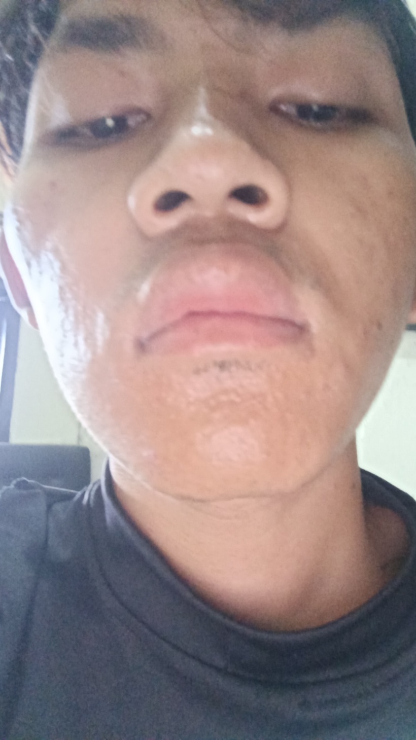 Bibir atas saya bengkak