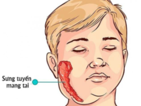 Bệnh quai bị có lây không