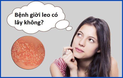 Bệnh giời leo: Có lây không và lây qua đường nào?