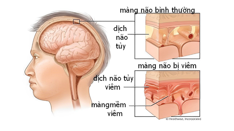 Viêm màng não có lây không?