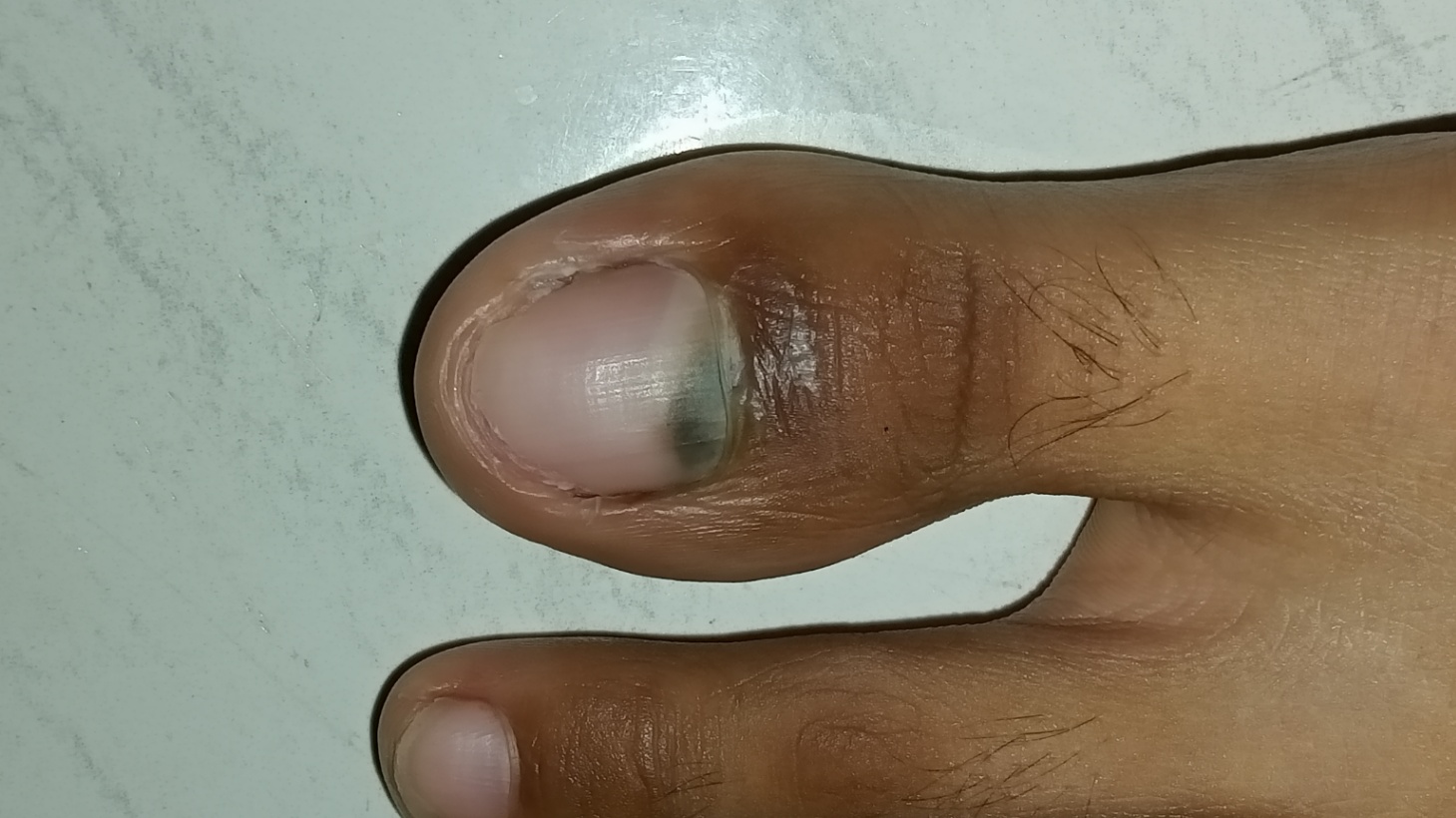 Kuku kaki hitam ungu gelap dan kulit permukaaan kuku mengelupas