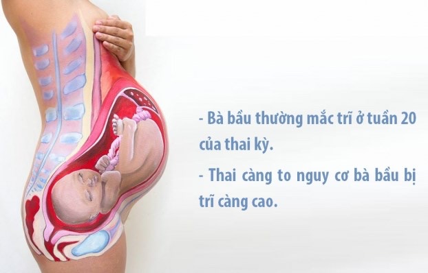 Bị trĩ khi mang thai phải làm sao