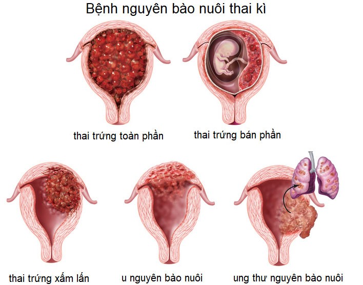 Mang thai trứng là gì? Có nguy hiểm không?