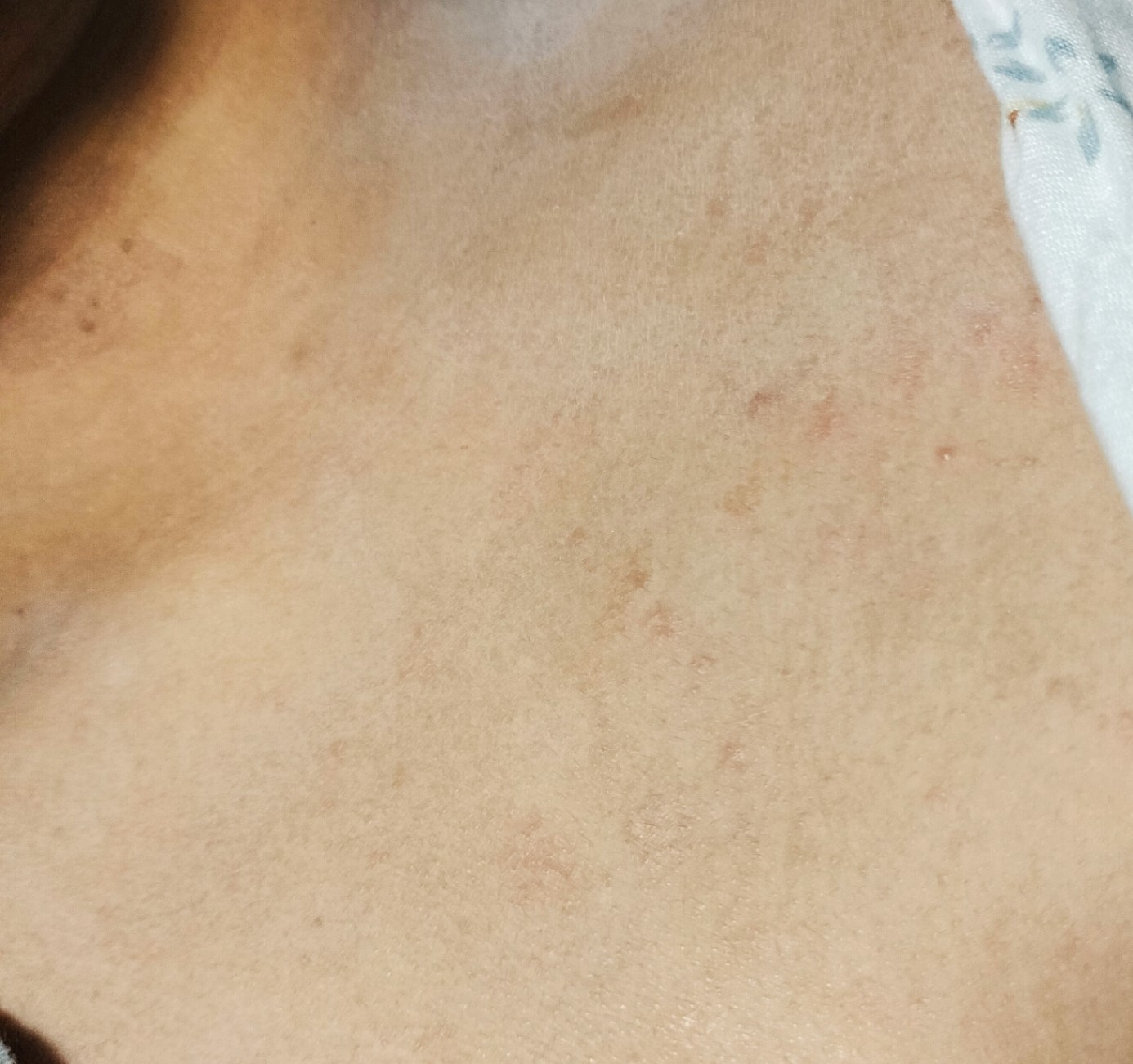 Dermatitis Kontak 