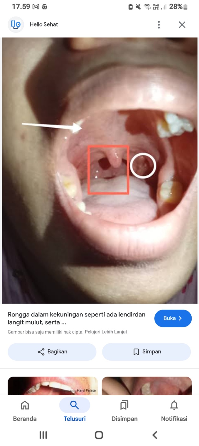 dok, izin bertanya.. ini kenapa ya ko ada bolongan sama ada putih' nya gitu di dinding mulut