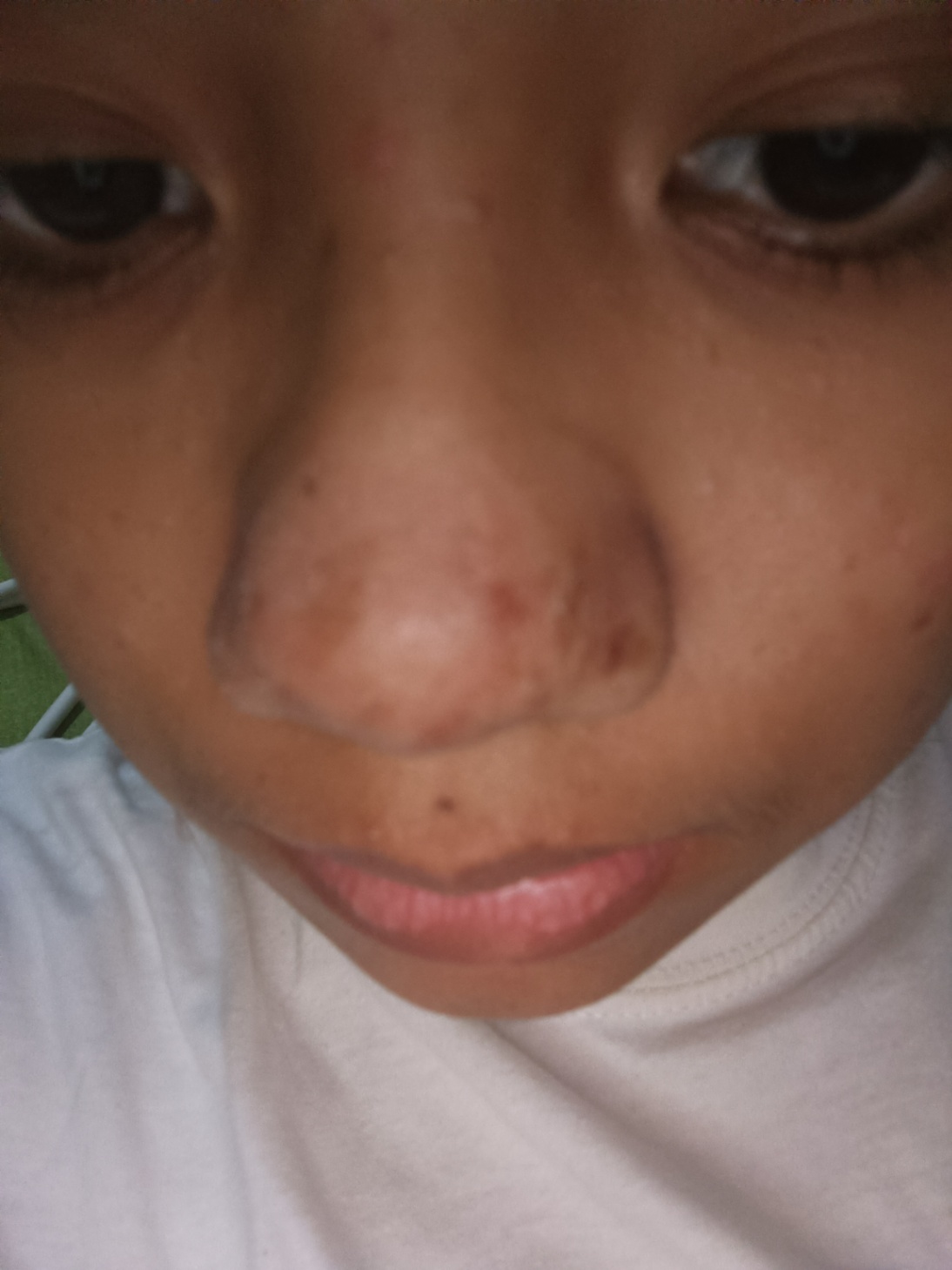 Flek hitam di hidung 