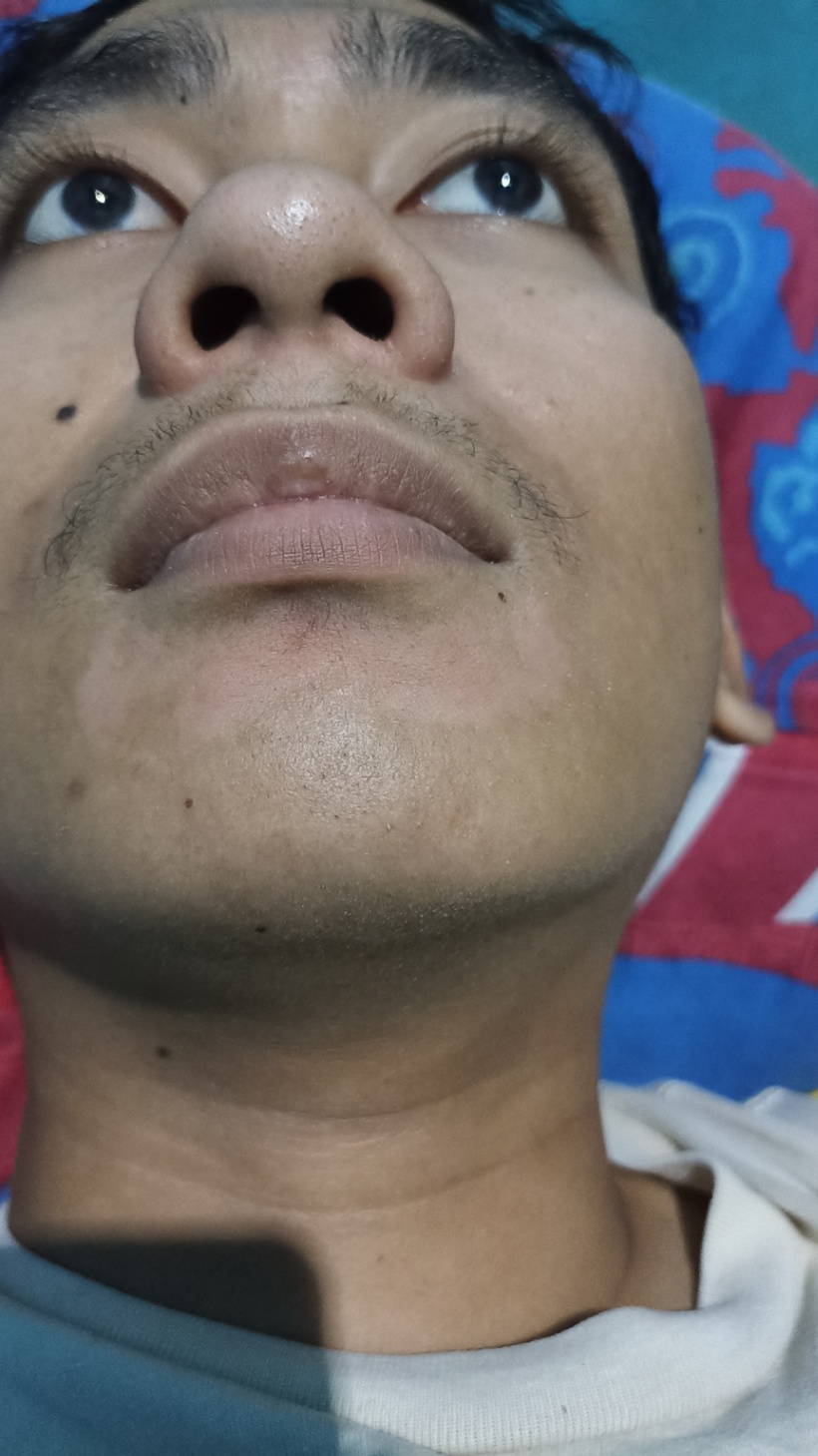 Bercak putih di area bawah Bibir dekat dagu