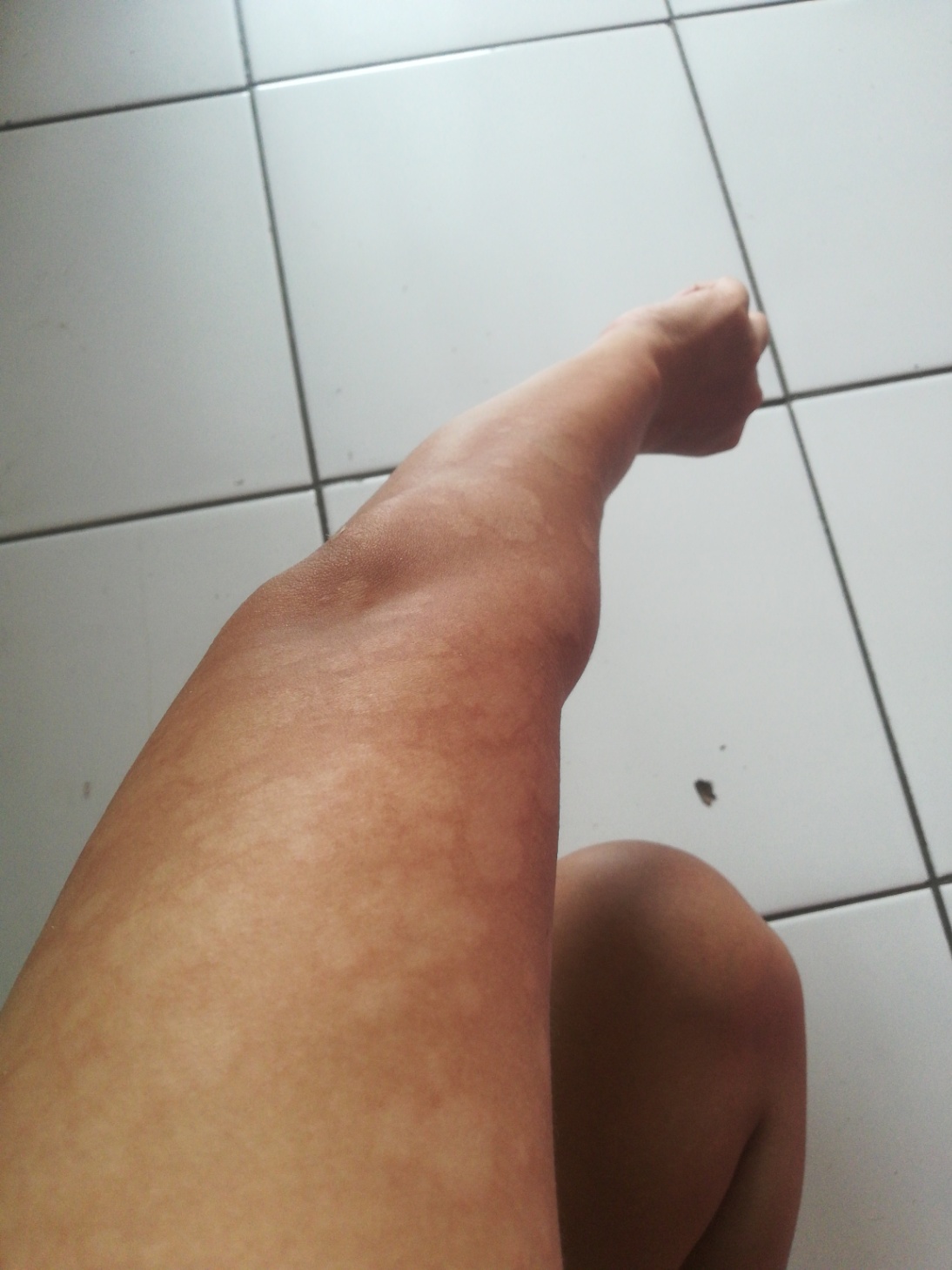 Badan timbul bercak putih d tangan dan bercak hitam kaki n badan