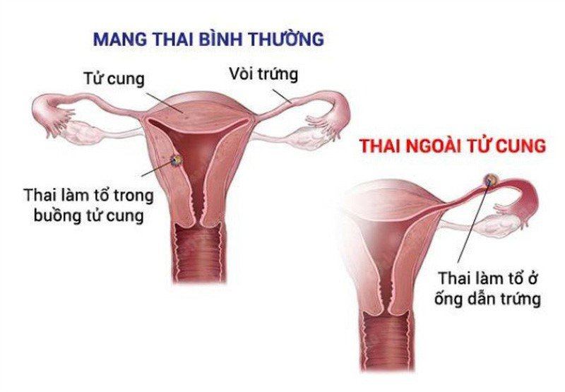 Mang thai ngoài tử cung là gì? 