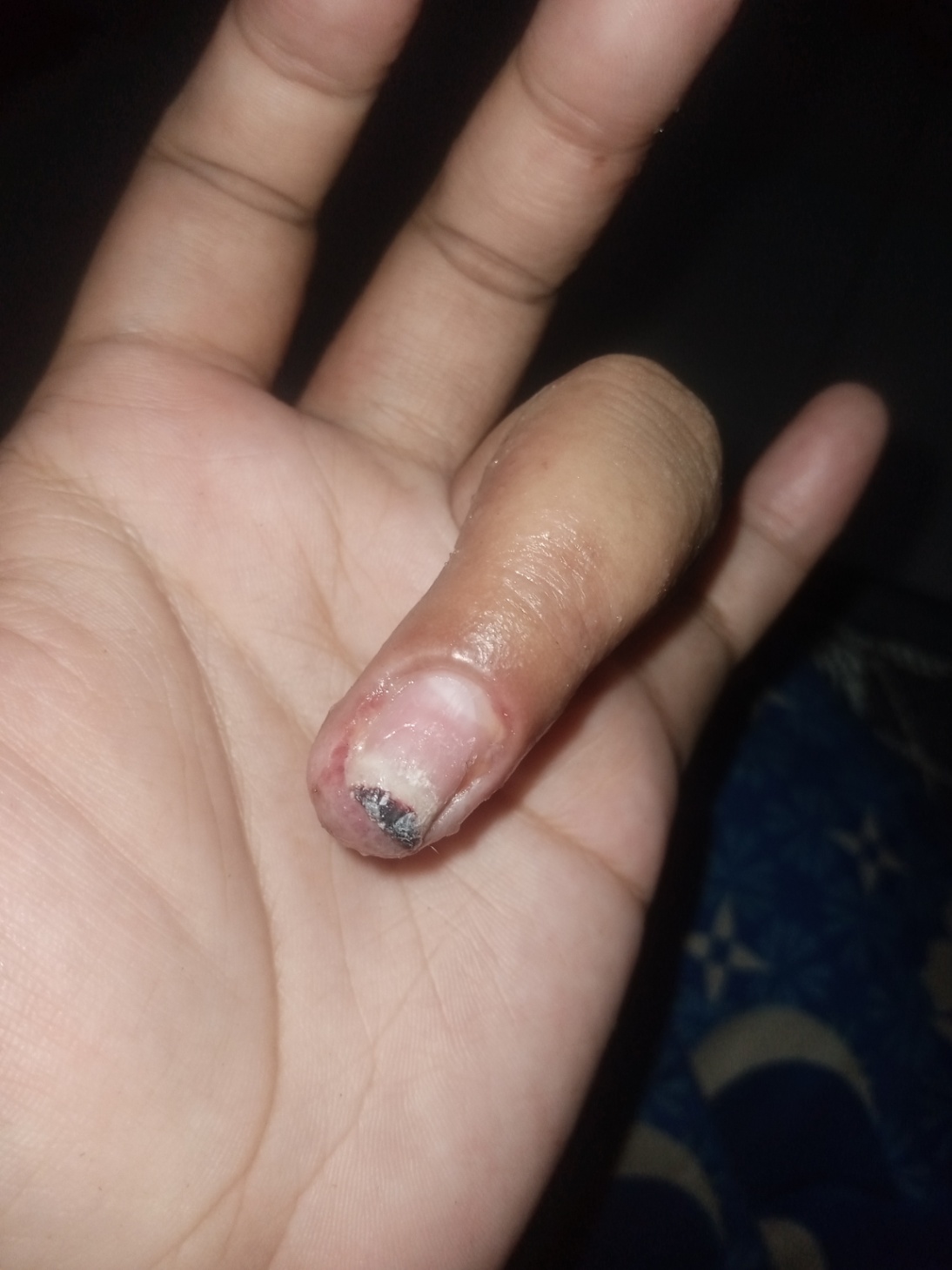 Kuku rusak akibat infeksi nail art