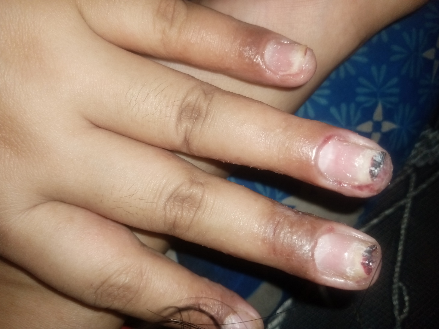 Kuku rusak akibat infeksi nail art