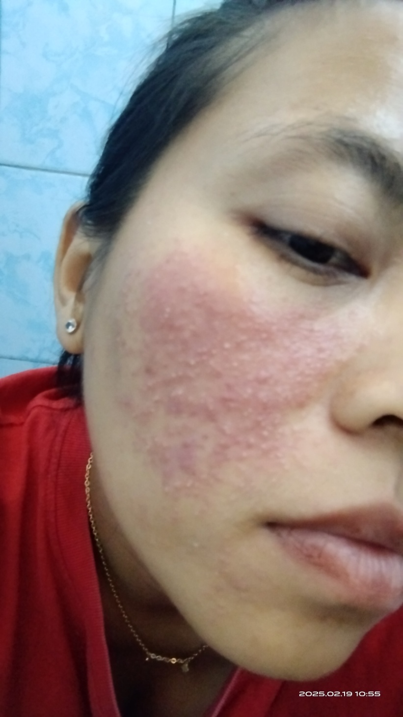 Eksim atau dermatitis