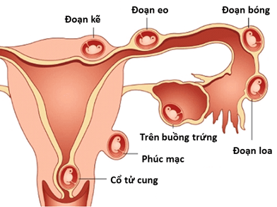 Làm gì khi phát hiện bị thai ngoài tử cung