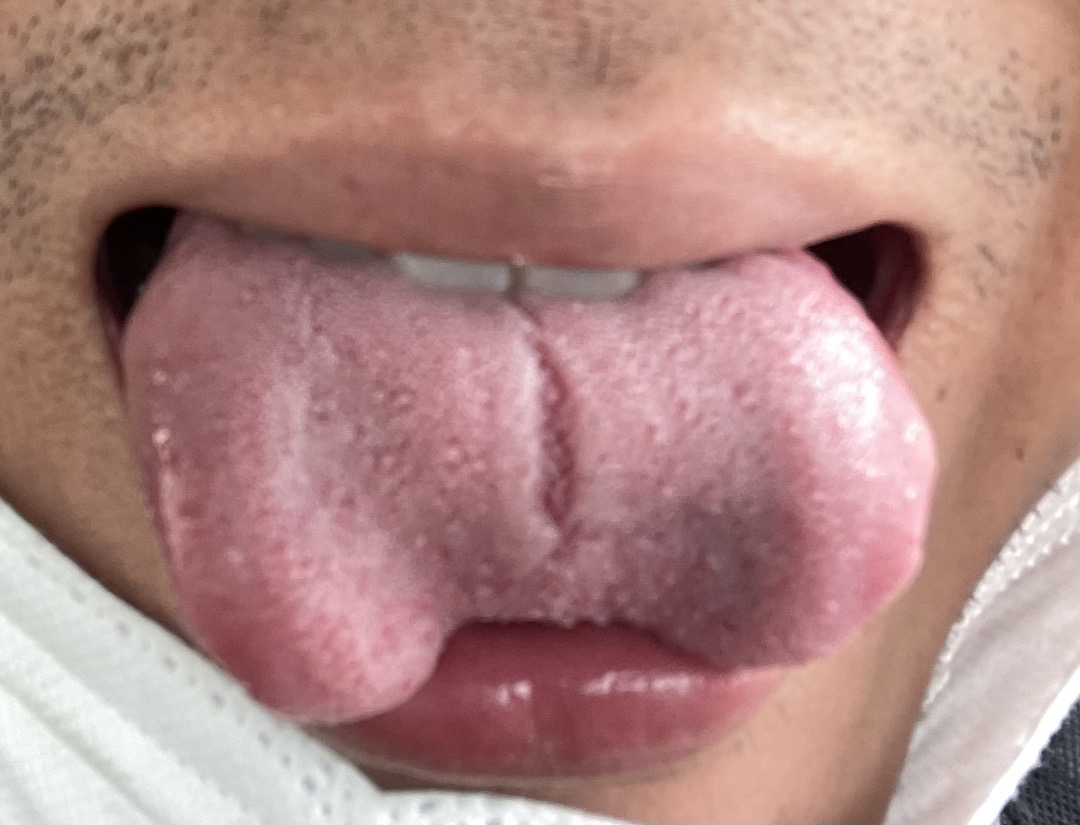 Bác sĩ cho em hỏi, lưỡi em bị ntn thời