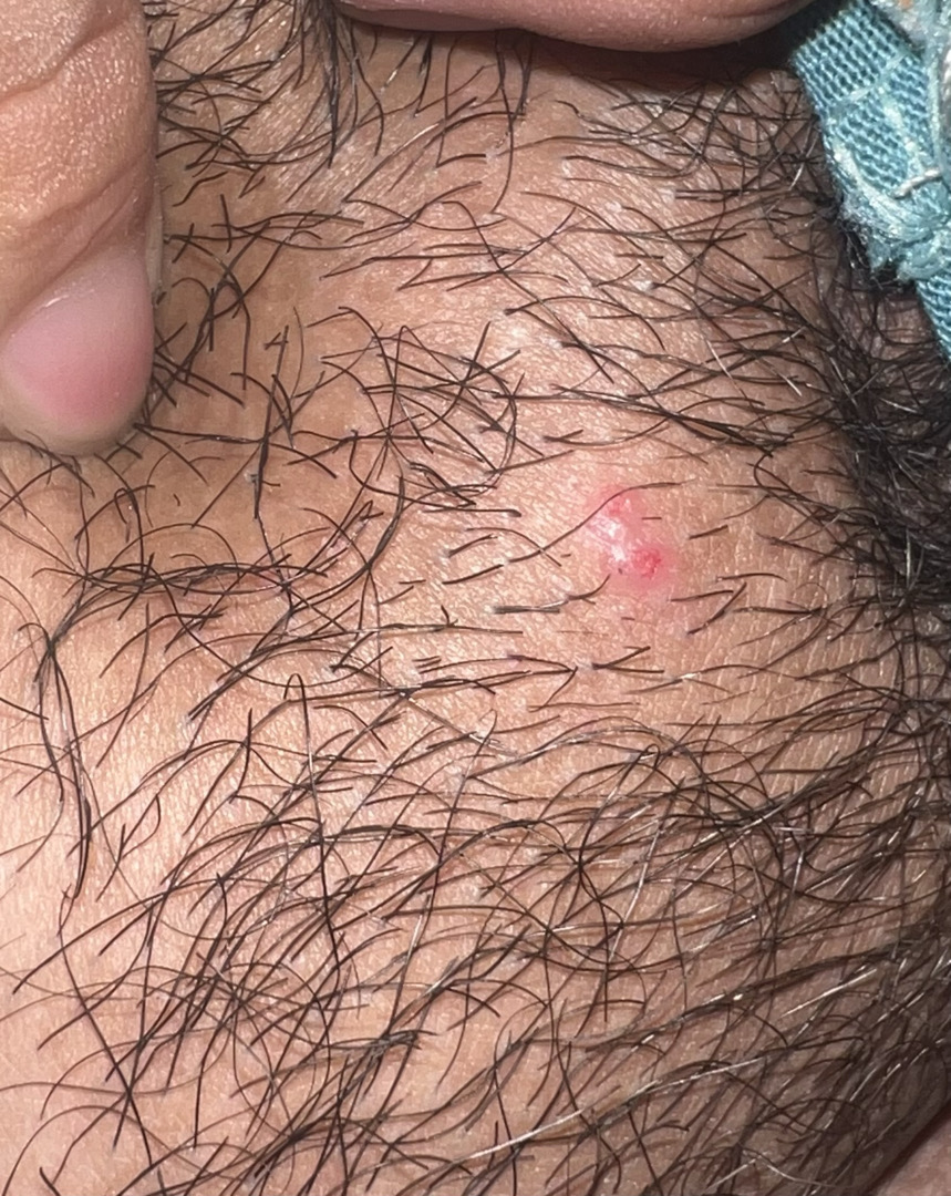 nổi mụn ở mu