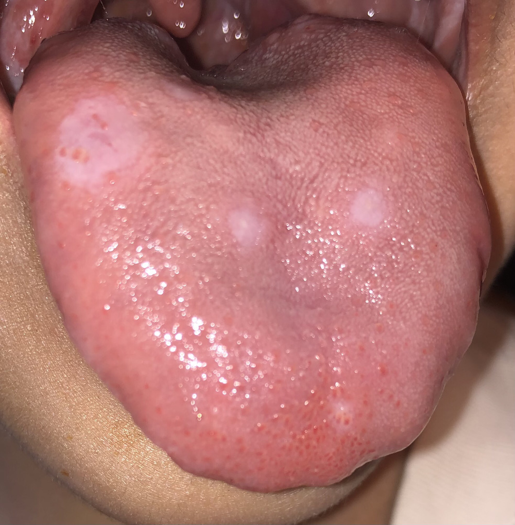 Lưỡi em bị các hột đỏ ở đầu lưỡi và