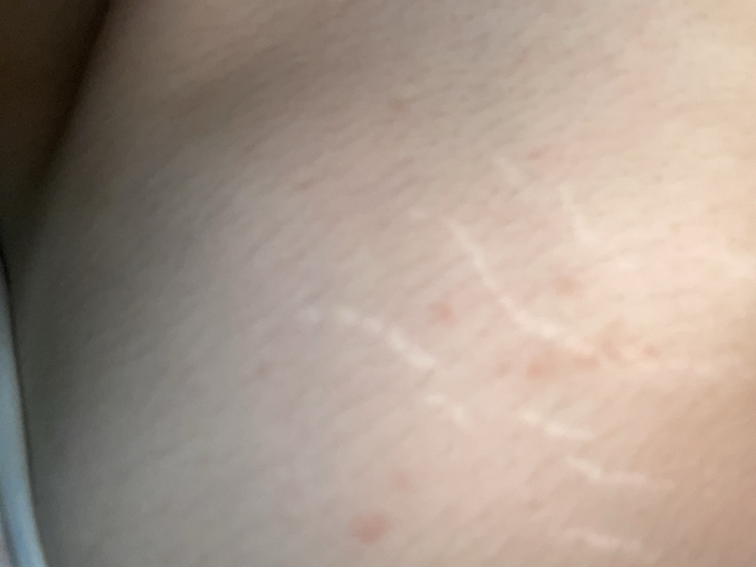 Ngứa vai, gãi, có thể không phải muỗi chích