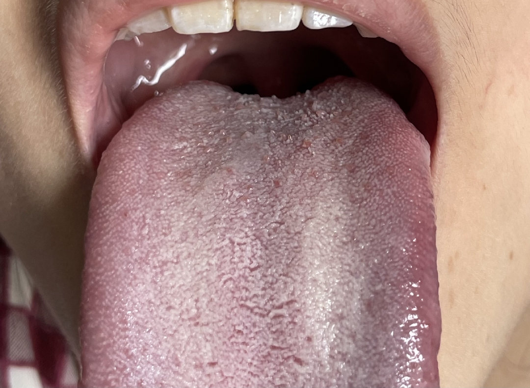 Sùi mào gà lưỡi hay viêm lưỡi