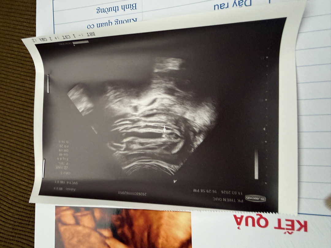 Hình ảnh siêu âm bé trai 17 tuần