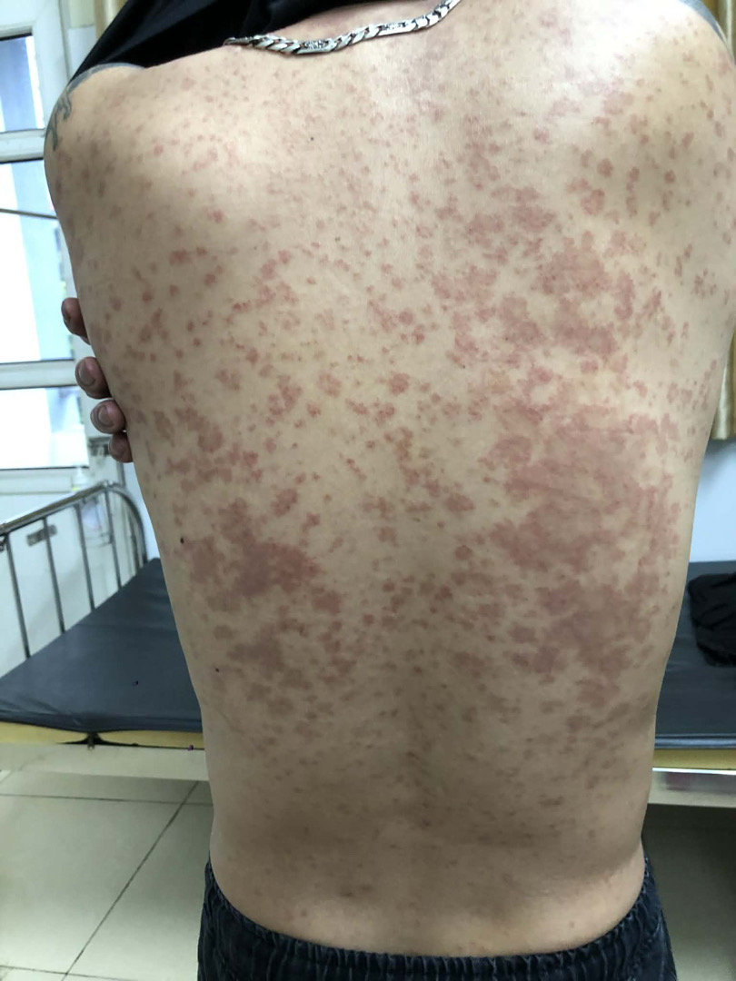 bác sỹ ơi cho e hỏi như này là bệnh gì a