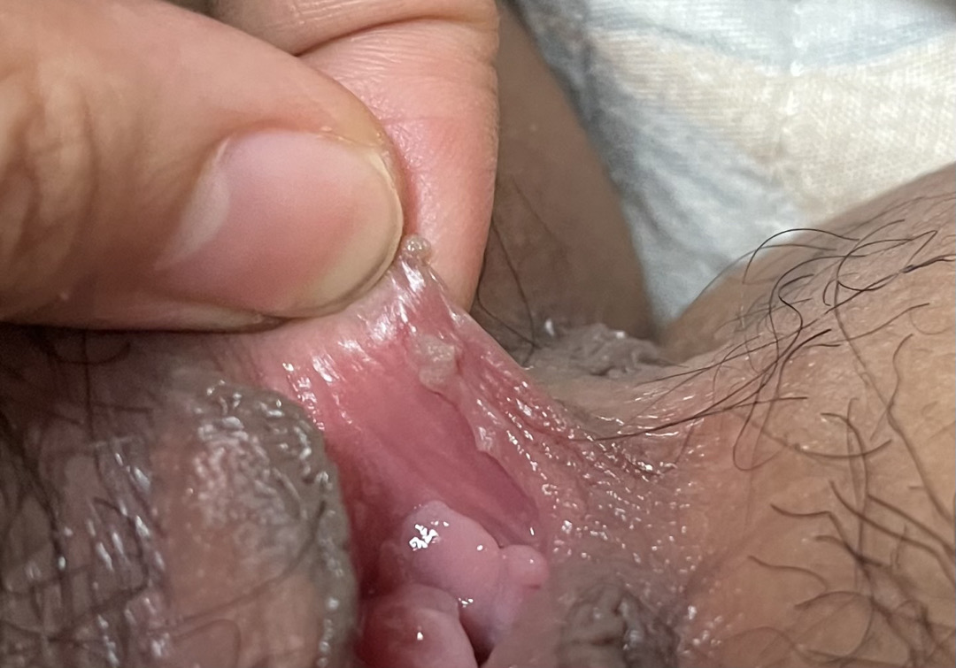 Dấu hiệu sùi mào gà và cách phân biệt triệu chứng nghi ngờ